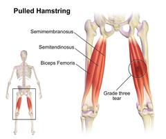 osteitis pubis