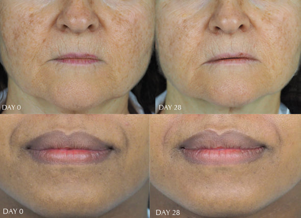 Sachi Skin - Before After results for hyperpigmantation