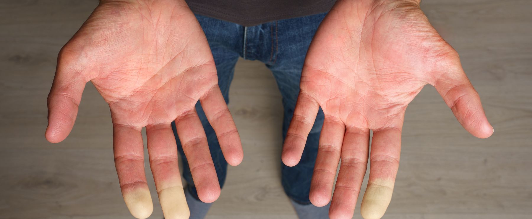 man holds out hands with blotchy skin