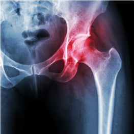 Hip Arthritis Causes and Risk Factors: Other Medical Conditions