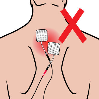 Electrode Placement for Electric Stimulation Charts