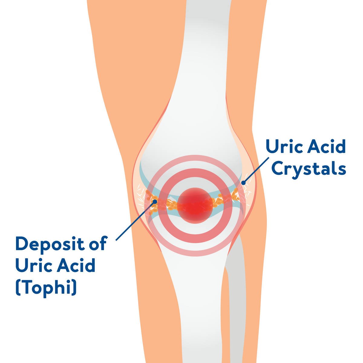 A knee graphic showing what happens with osteoarthritis