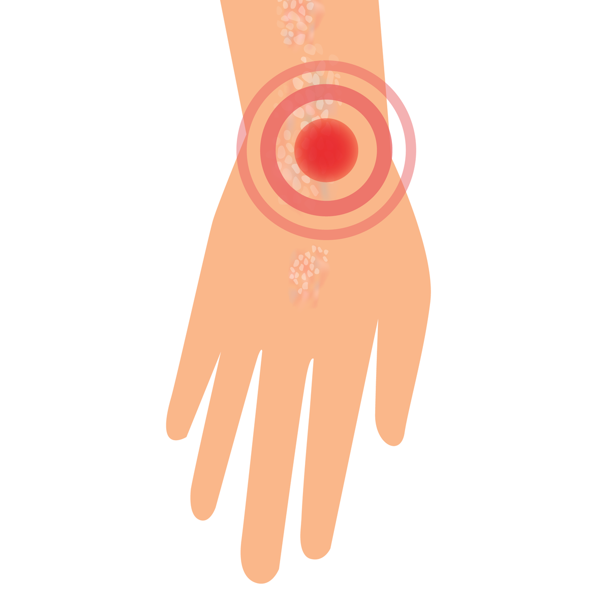 A hand graphic with red markings showing psoriasis