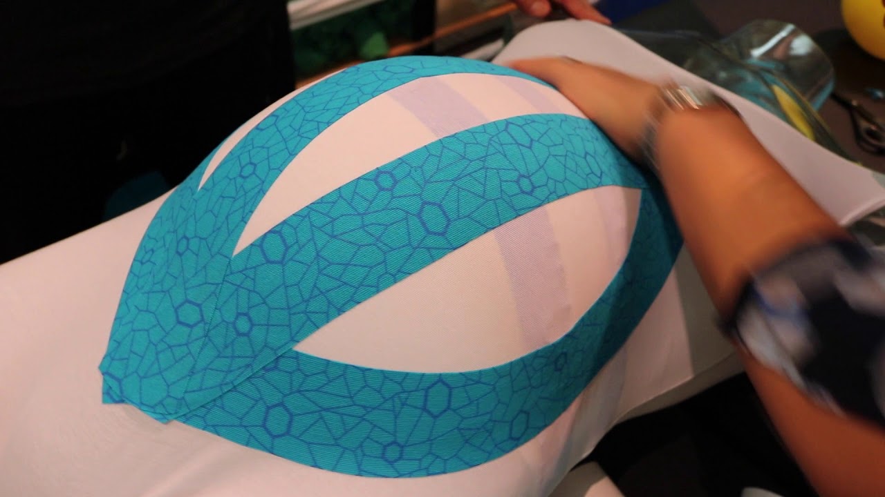 Masking the Pain of Pregnancy with Kinesiology Tape