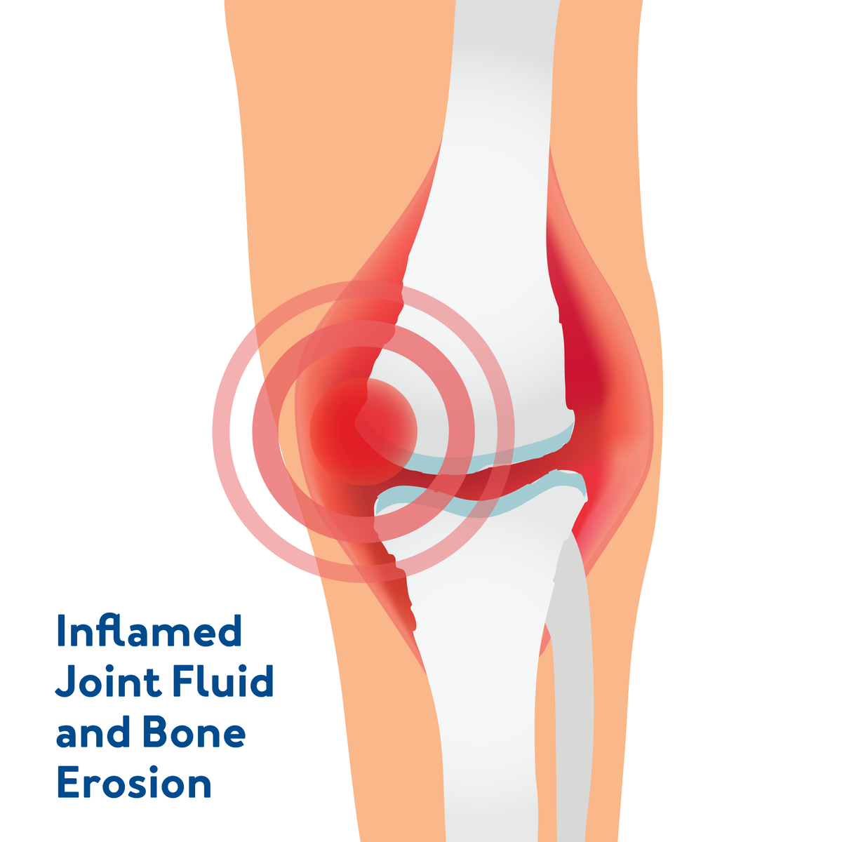 A knee graphic showing what happens with rheumatoid arthritis