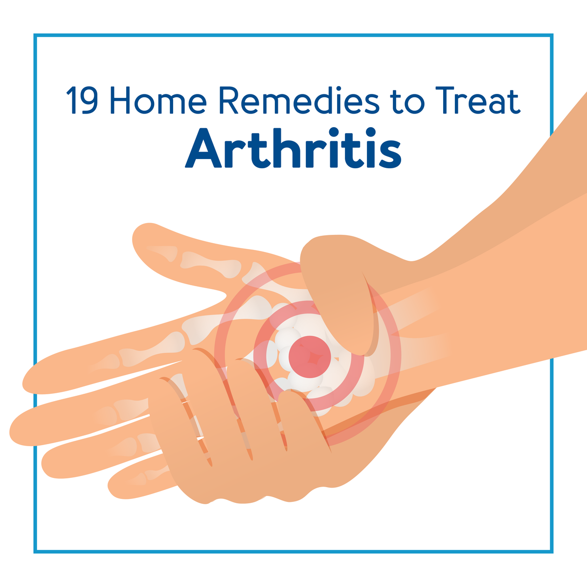 A graphic of a hand with arthritis. Text, 19 home remedies to treat arthritis