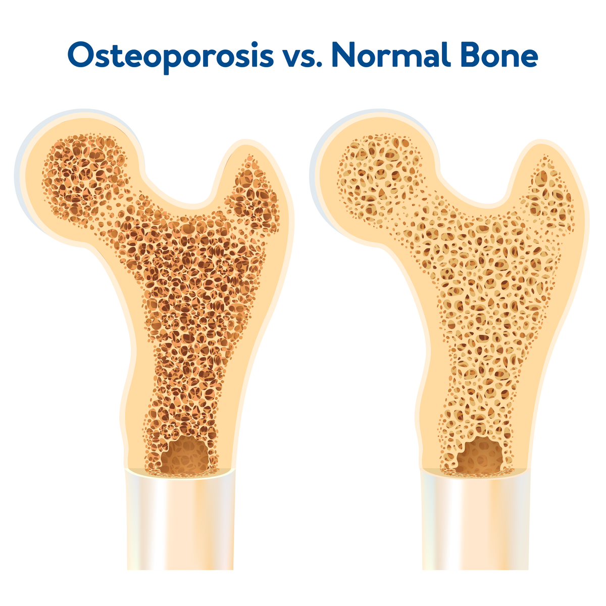 Osteoporosis vs. Normal Bone