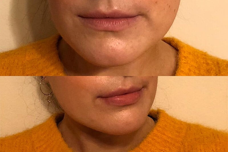 A close up of the before and after progress from using the reVive Lip Care Light Therapy System