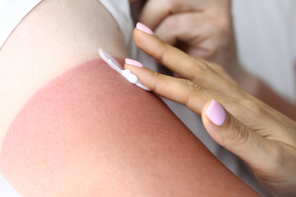 A person applying lotion to their sun burn