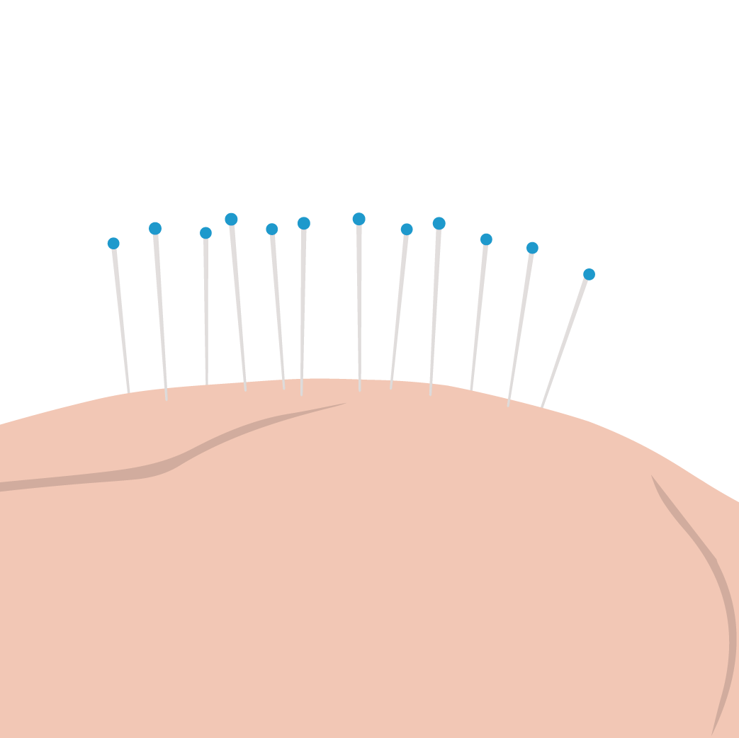 A graphic of acupuncture needles on skin