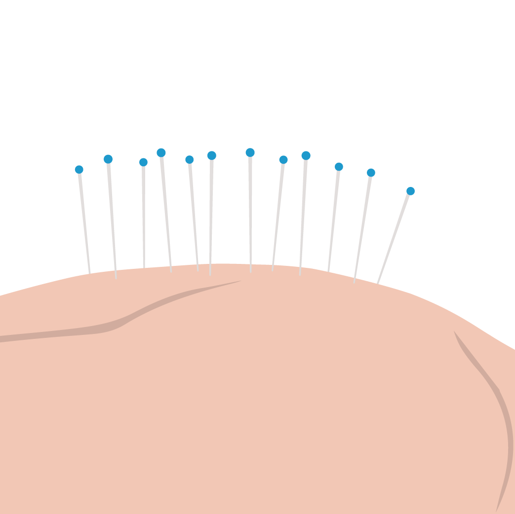 https://cdn.shopify.com/s/files/1/0240/6504/8681/t/34/assets/pf-56223d30--2020PainManagementGuideAccupuncture_1200x.png?v=1584384705