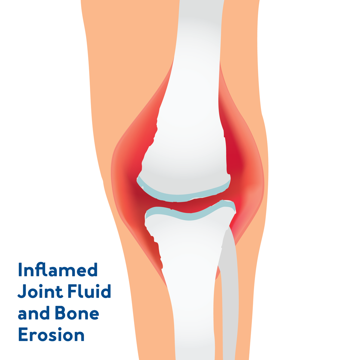 A graphic of a knee with inflammatory arthritis. Text, Inflamed joint fluid and bone erosion