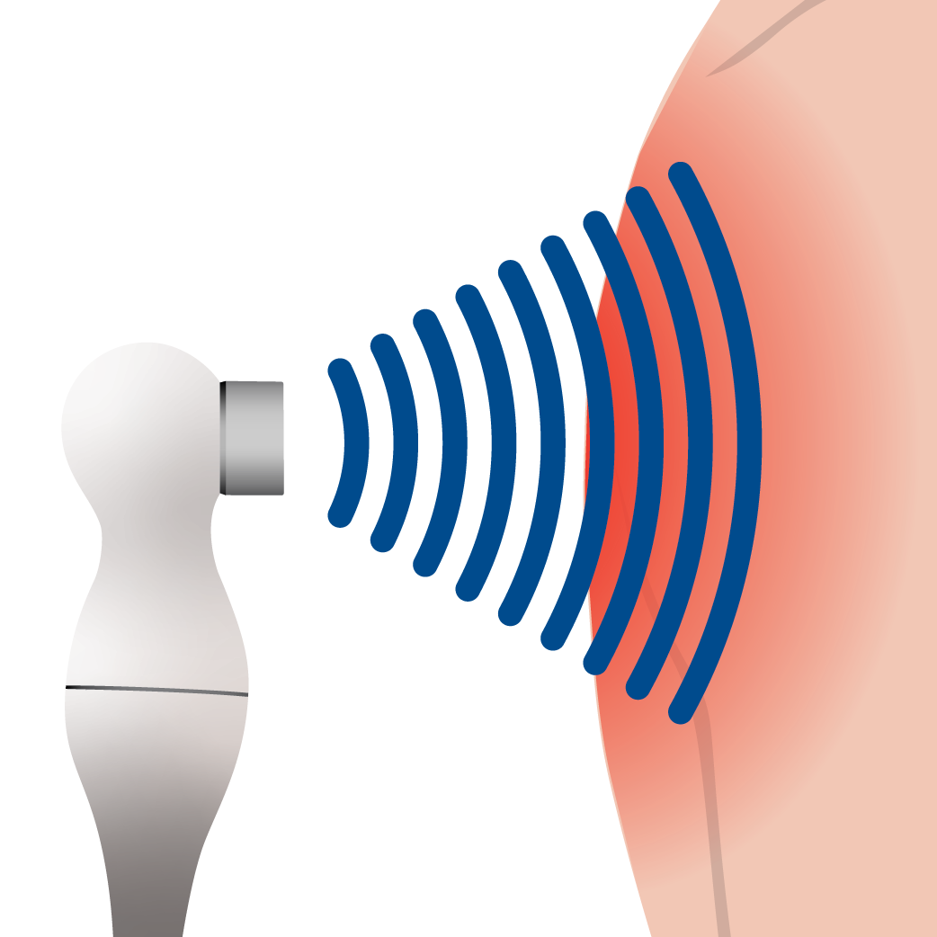 A graphic of a thermal ultrasound therapy device being used on skin that’s red