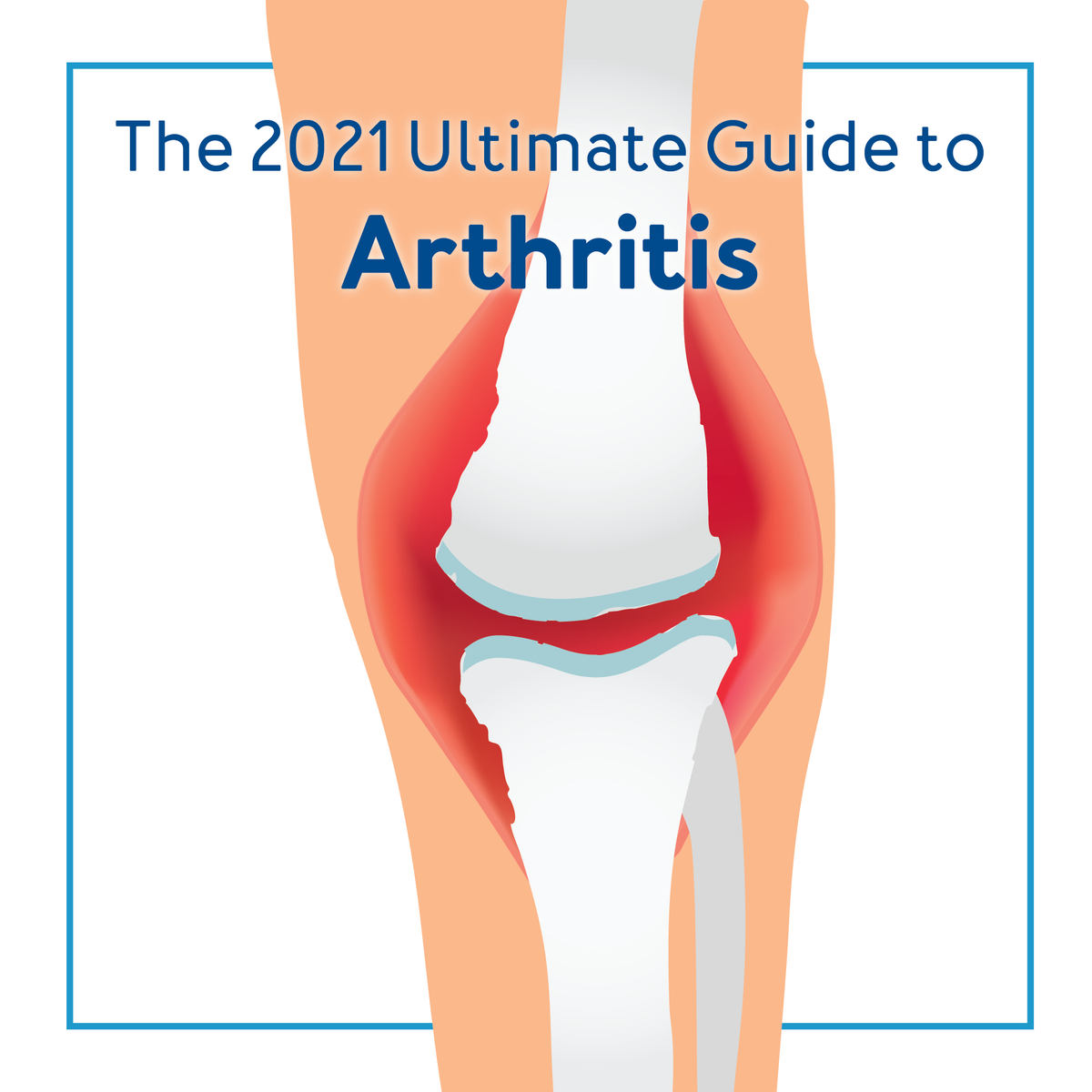 Graphic of knee and bones with red and text The Ultimate Guide to Arthritis