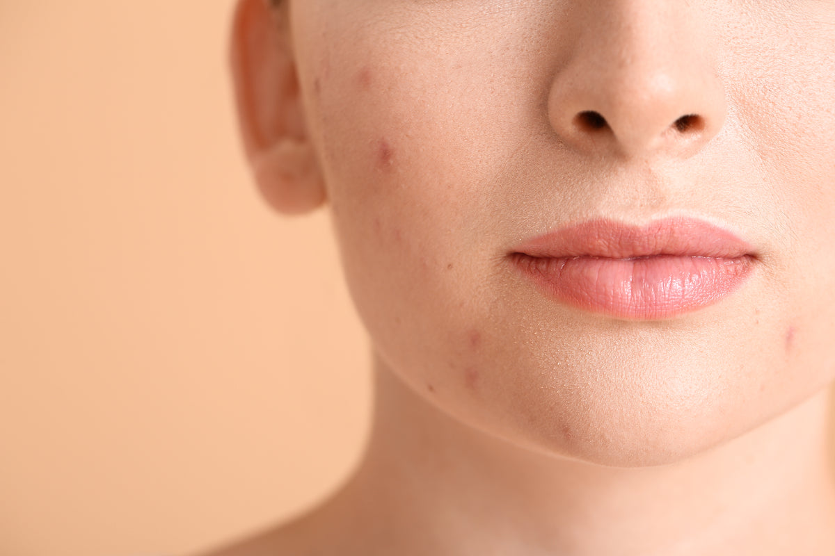 A womans face with acne