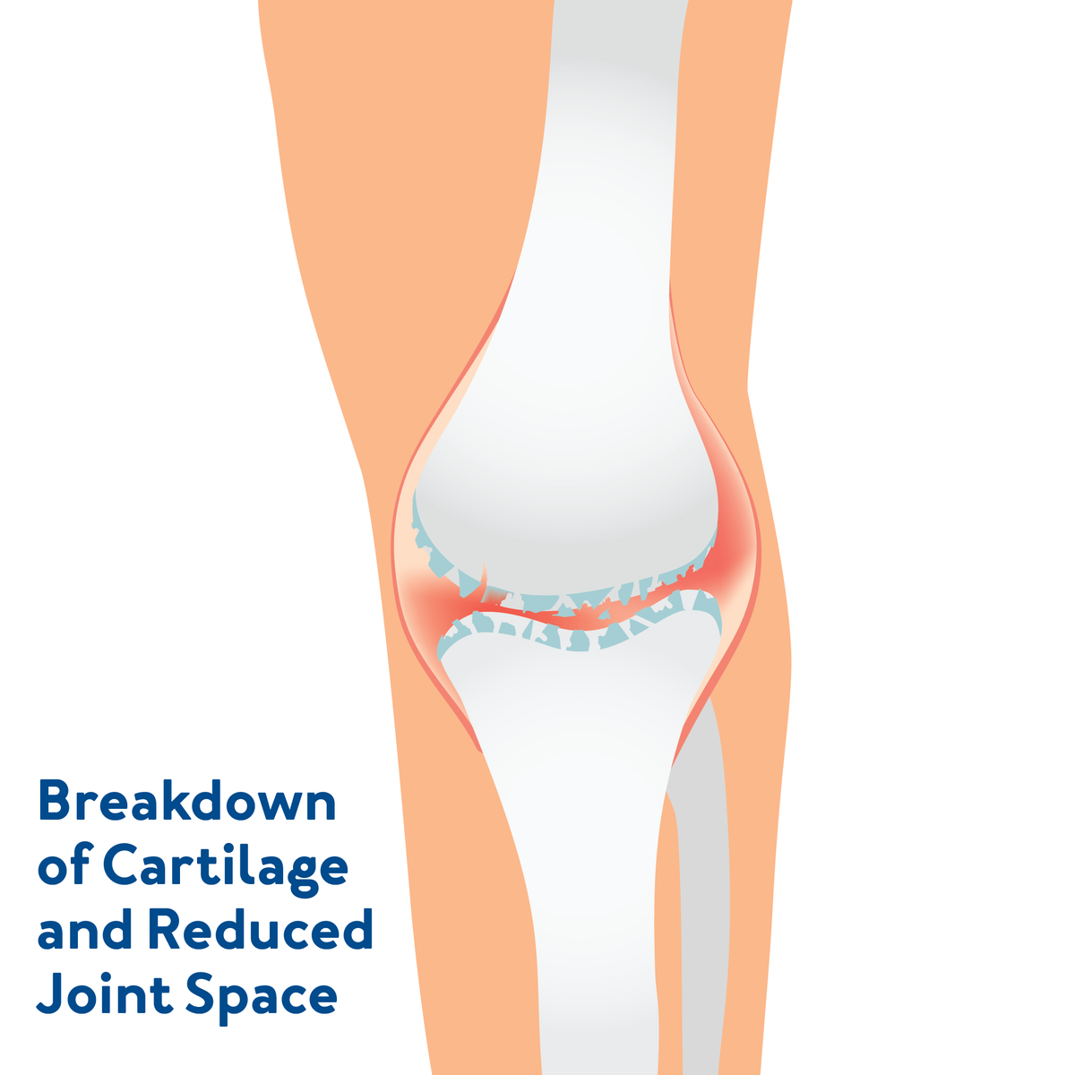 A graphic of a knee with degenerative arthritis. Text, Breakdown of cartilage and reduced joint space