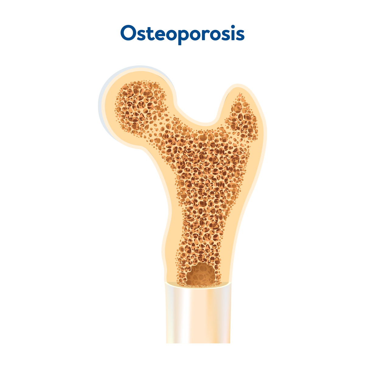 A graphic showing osteoporosis bone density