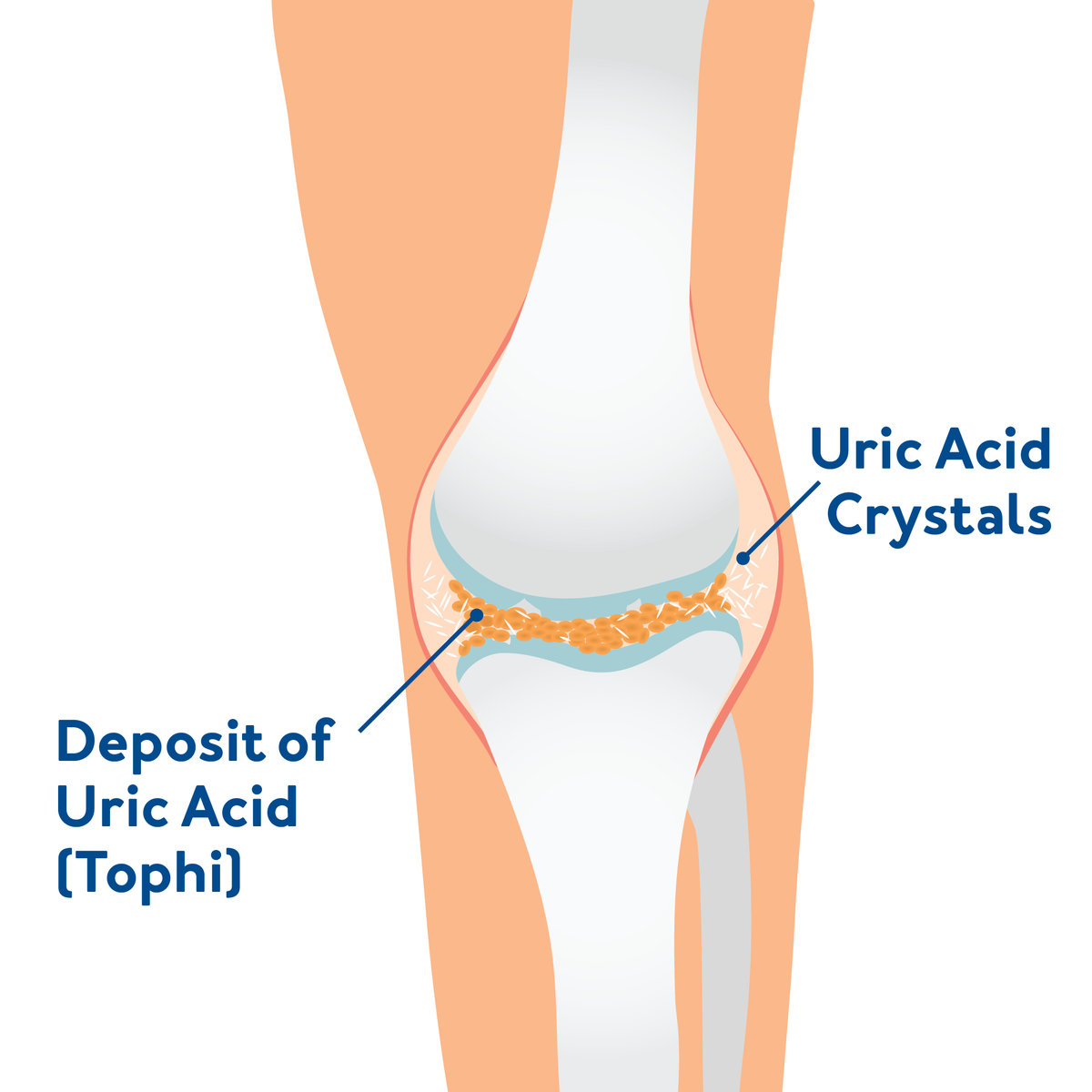 A graphic of a knee with metabolic arthritis. Text, deposit of uric acid (tophi) and uric acid crystals