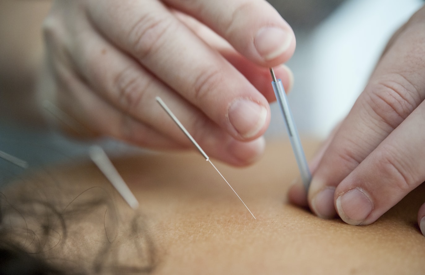 Close up of needles being placed in a person’s back