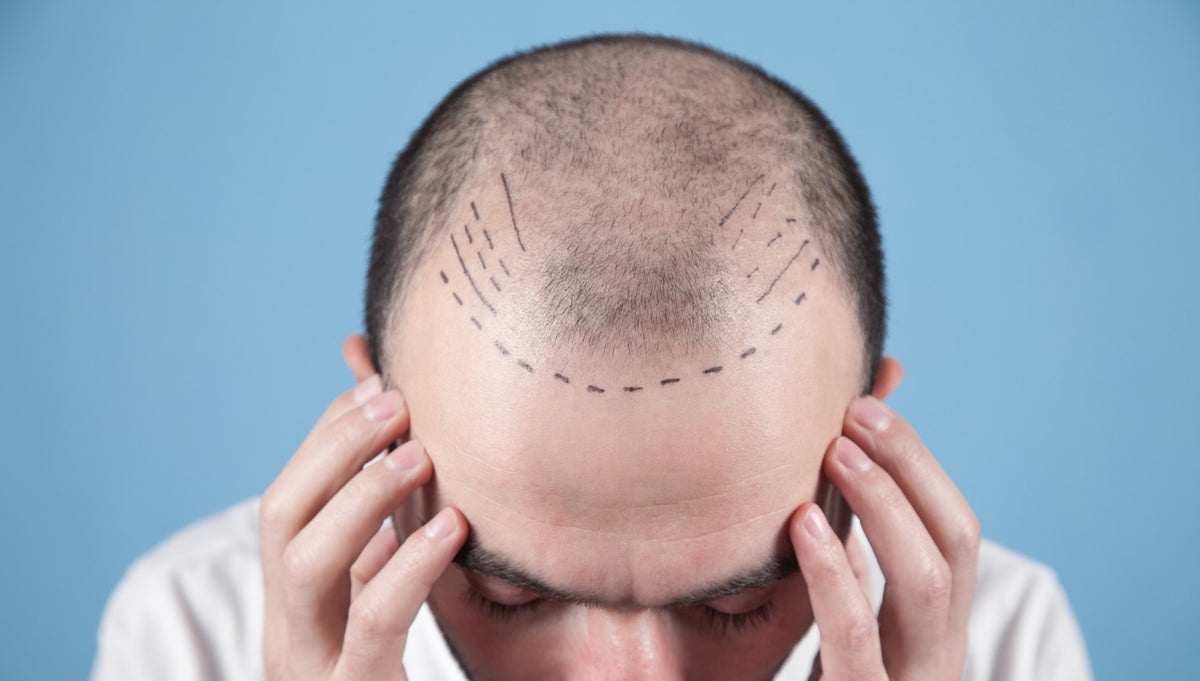 A mans balding head with pen marks on it
