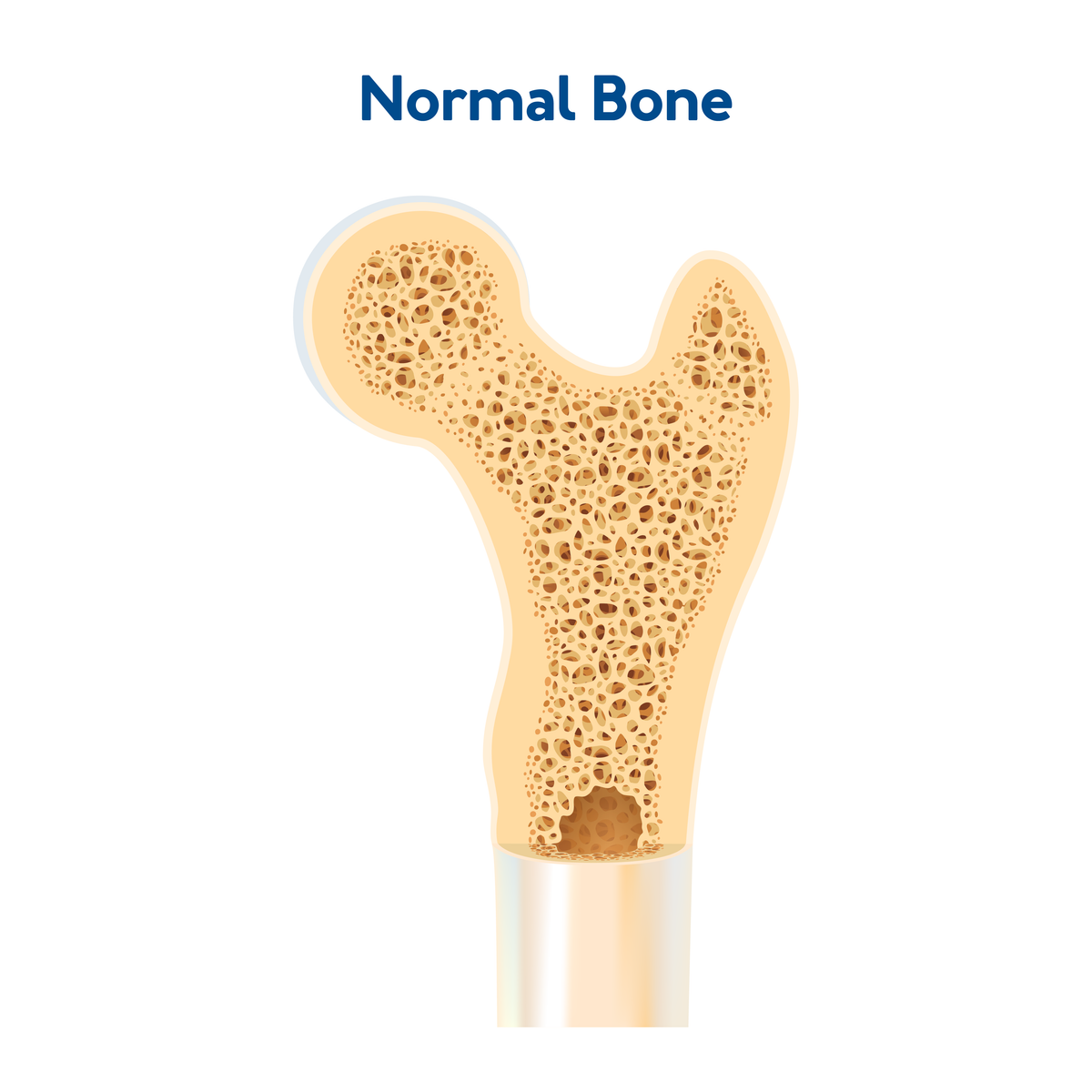 A graphic showing normal bone density