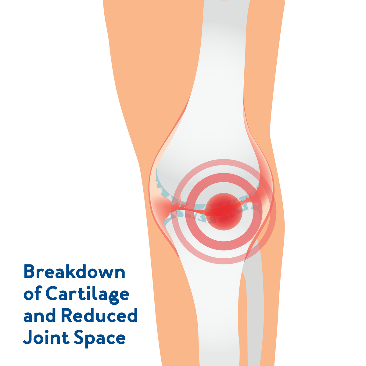 A knee graphic showing what happens with bursitis