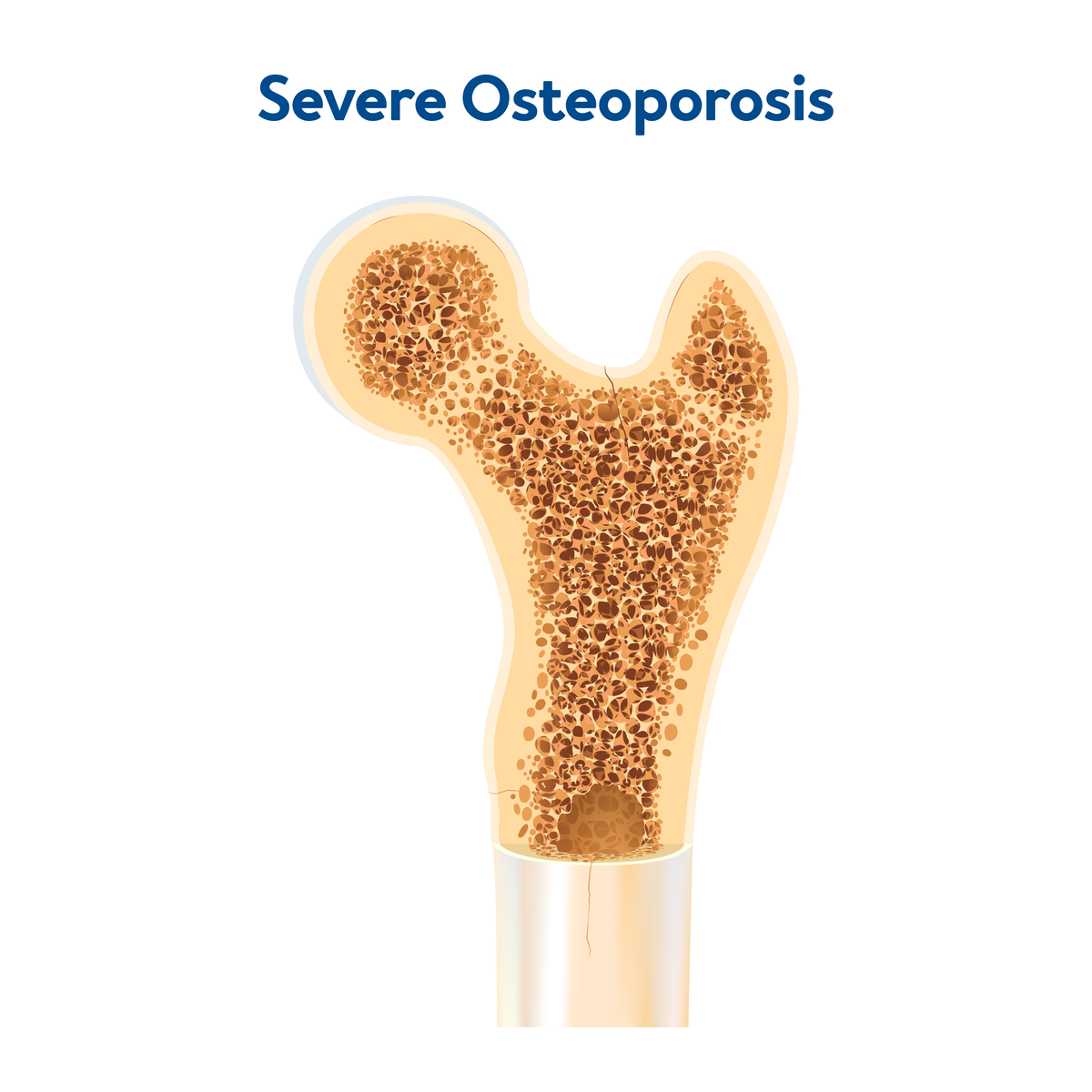 A graphic showing severe osteoporosis bone density