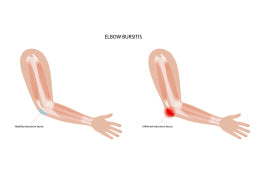 Two cartoon arms with text, “elbow bursitis”