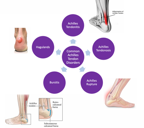 Achilles Tendinitis: Types, Symptoms, Causes, Diagnosis, Treatment, and More
