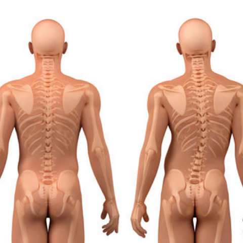 scoliosis spine curvature