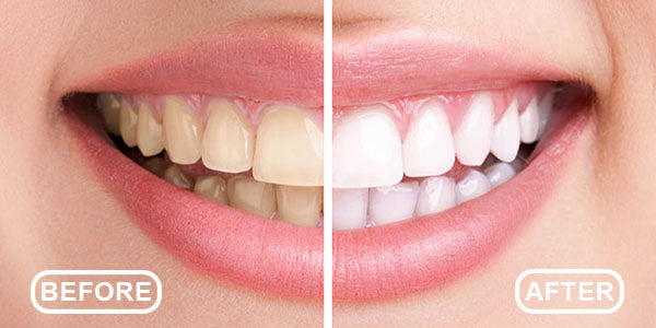 Teeth Whitening Kit Before and After