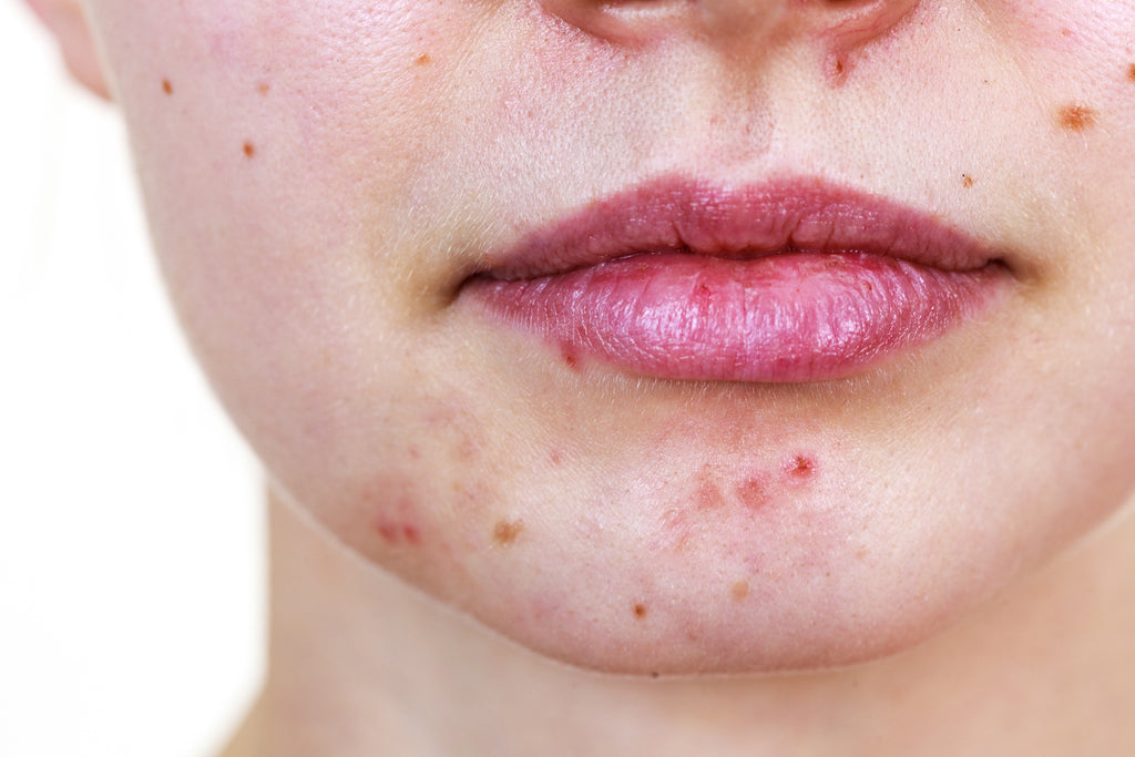 what-the-acne-face-map-reveals-about-your-overall-health-m-n