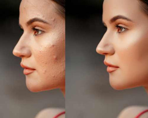 Liquid blush on acne prone skin