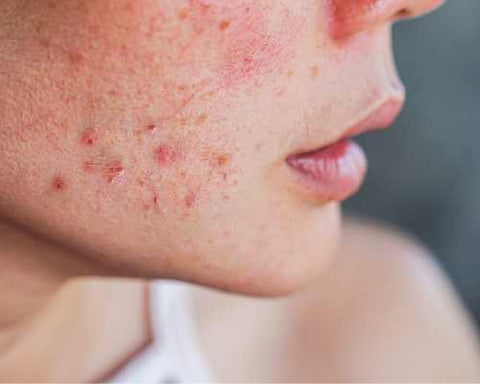 Liquid Blush for acne prone skin