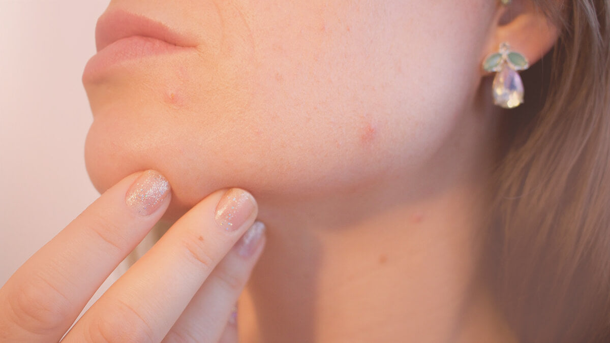 Heal adult acne with probiotics