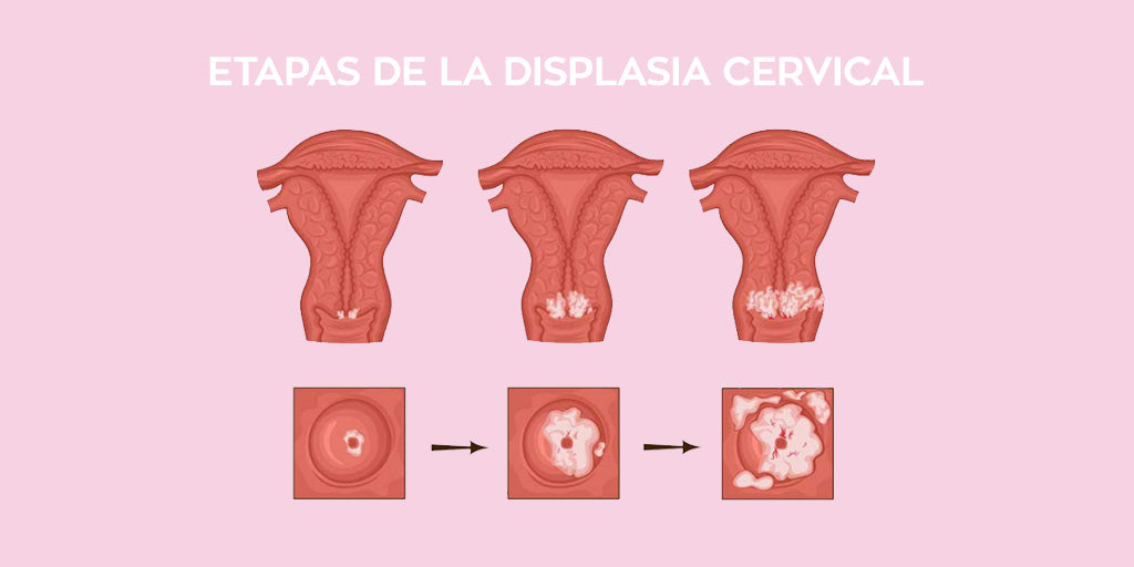 cervical dysplasia
