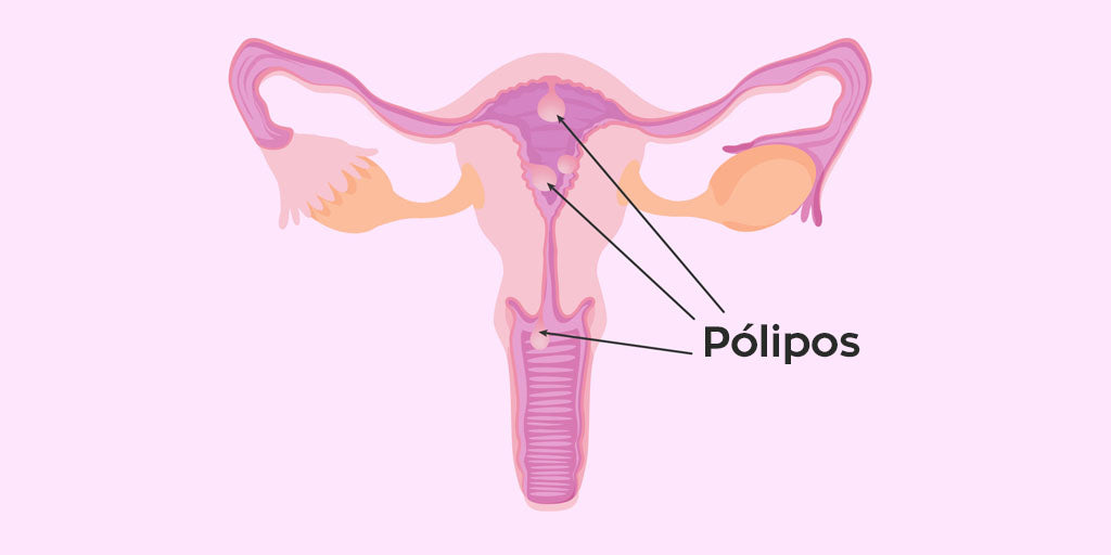 endometrial polyps