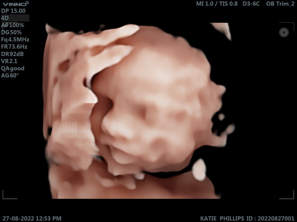 Ultrasound of baby Oliver