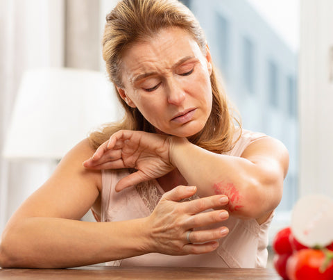 woman with skin rash or dermatitis as a symptom of gluten sensitivity