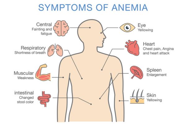Symptom of anemia