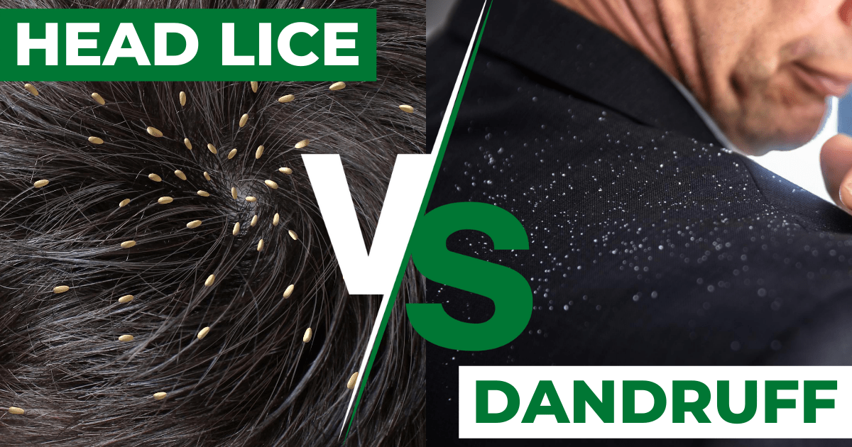 Head Lice Eggs Vs Dandruff