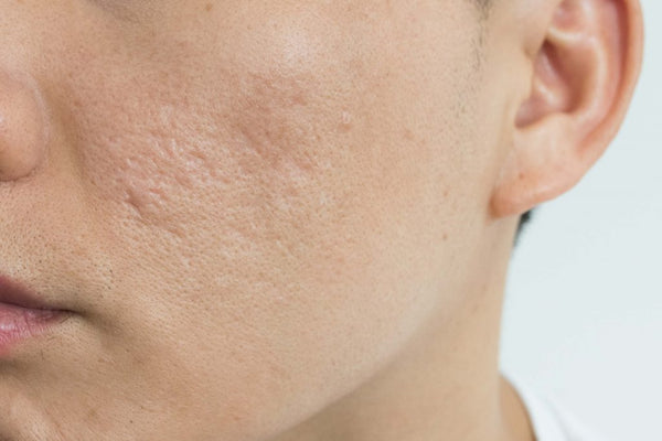 ACNE TREATMENTS concave scars