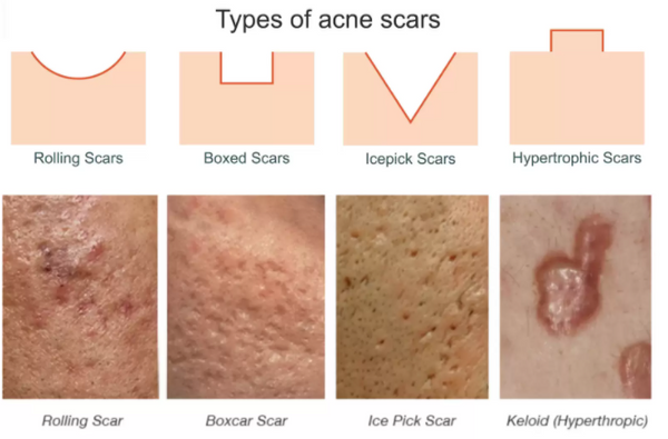 ACNE SCAR TREATMENT