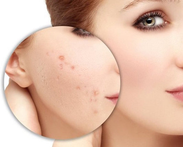 who need acne scar treatment