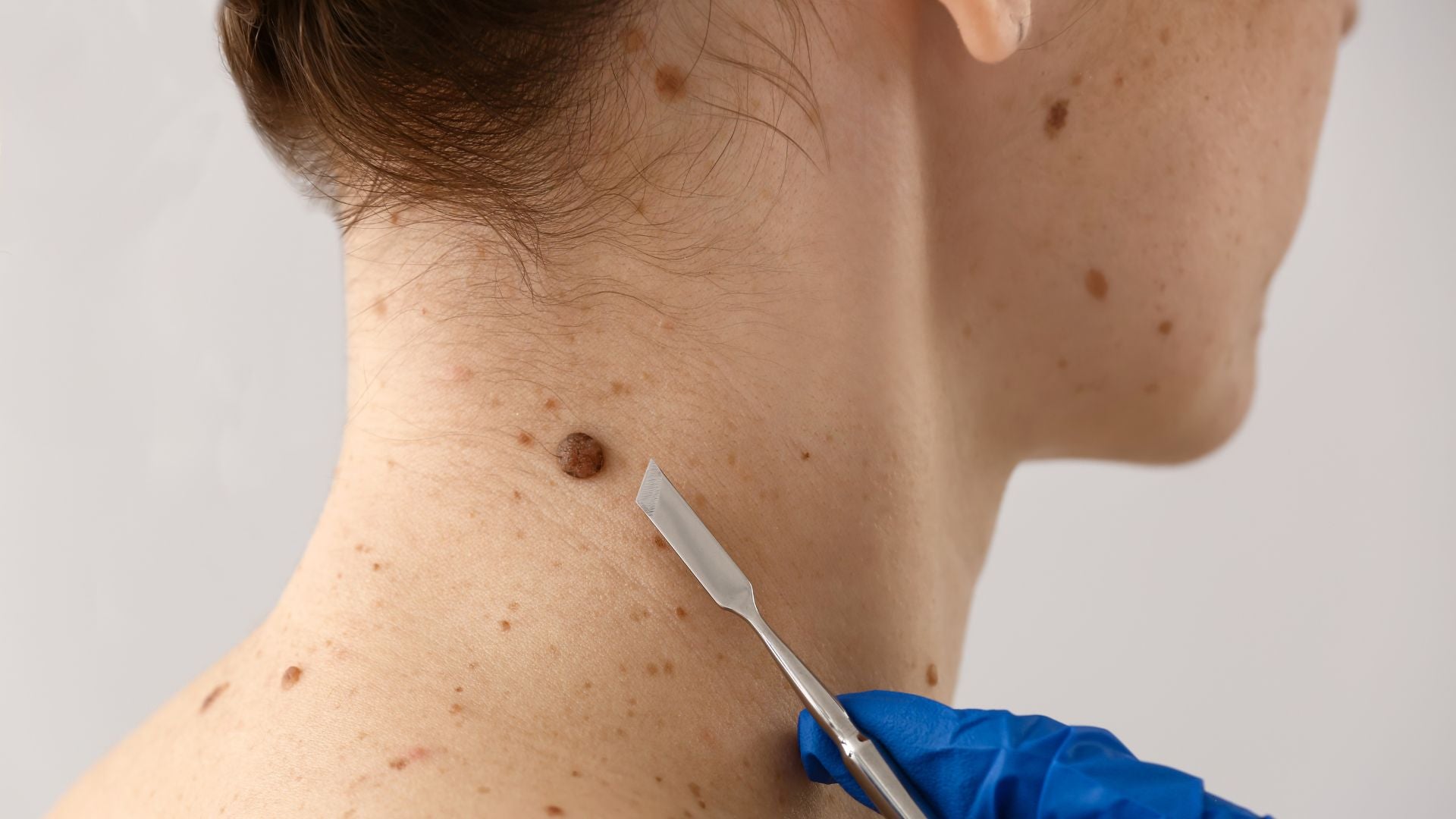 A mole on the back of a woman's neck