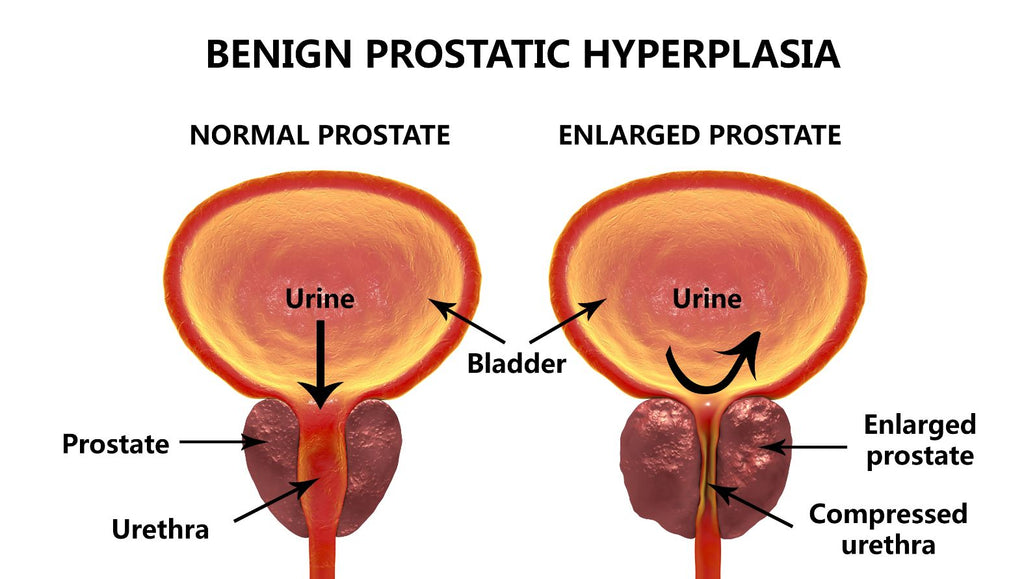 enlarged-prostate-gland-overview-vastmedic