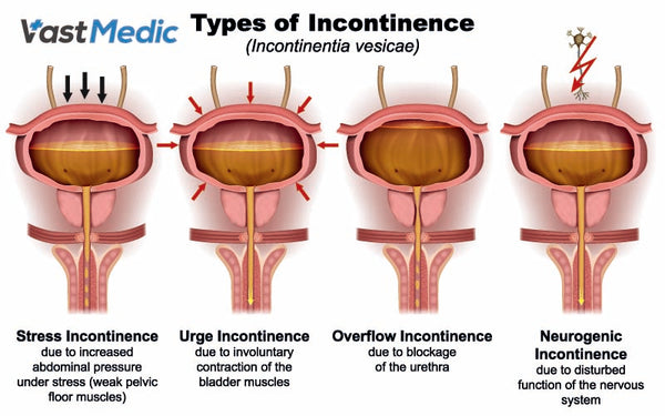 What Causes Bladder Incontinence In Men