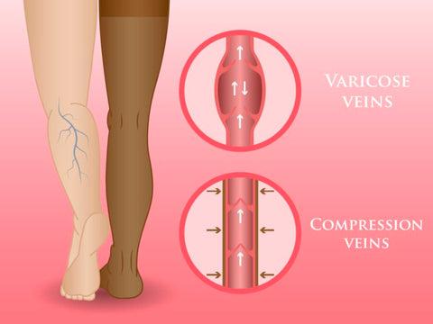 Compression Socks for Varicose Veins