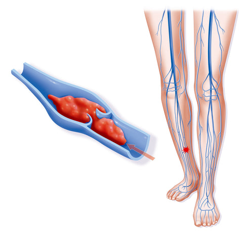 Compression Socks for veins Thrombosis