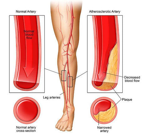 Diabetic Compression Socks Leg Illustration